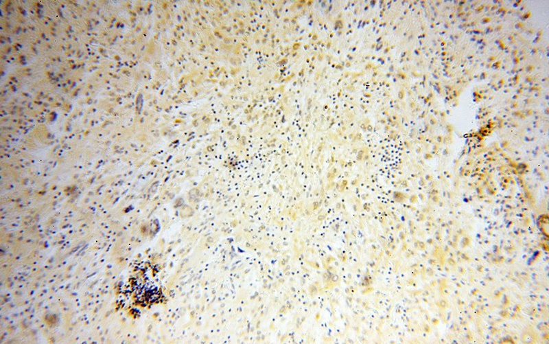 Immunohistochemical of paraffin-embedded human gliomas using Catalog No:110440(FABP4 antibody) at dilution of 1:50 (under 10x lens)