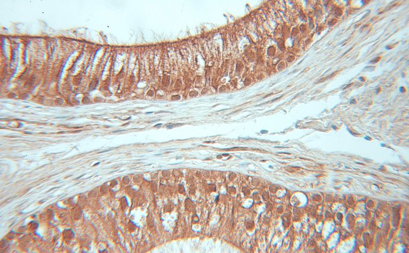 Immunohistochemical of paraffin-embedded human prostate cancer using Catalog No:109742(CUL2 antibody) at dilution of 1:50 (under 40x lens)