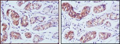 Immunohistochemical analysis of paraffin-embedded human stomach cancer tissues using PGA5 mouse mAb with DAB staining.