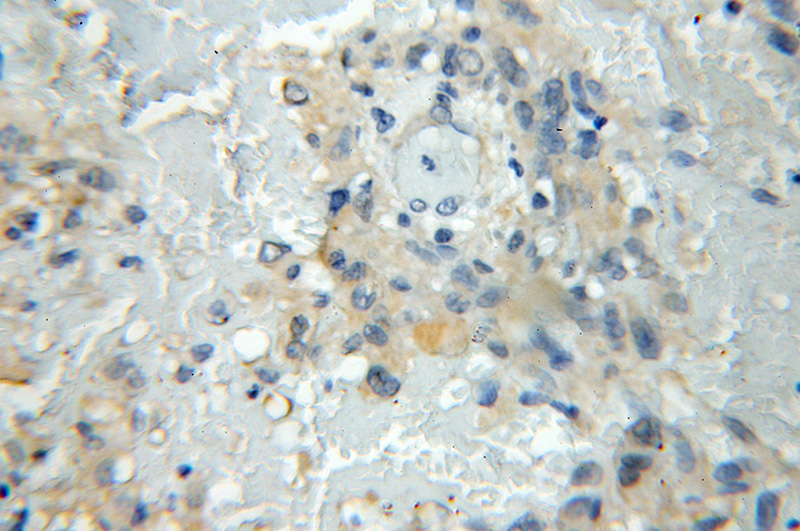 Immunohistochemical of paraffin-embedded human gliomas using Catalog No:117205(UBL7 antibody) at dilution of 1:50 (under 10x lens)