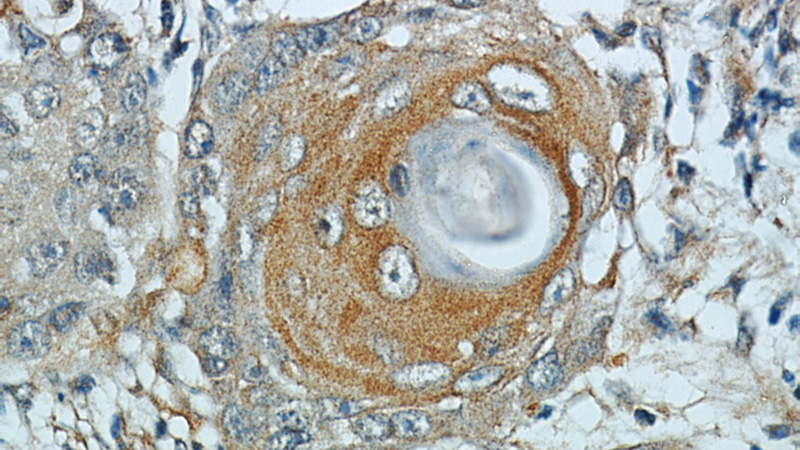 Immunohistochemical of paraffin-embedded human lung cancer using Catalog No:112892(MUC8 antibody) at dilution of 1:50 (under 40x lens)