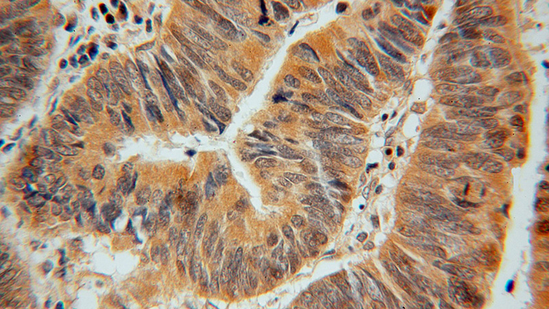 Immunohistochemical of paraffin-embedded human colon cancer using Catalog No:107793(ADI1 antibody) at dilution of 1:100 (under 40x lens)