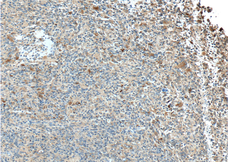 Immunohistochemistry of paraffin-embedded human gliomas tissue slide using Catalog No:112276(CD107a Antibody) at dilution of 1:50 (under 10x lens)