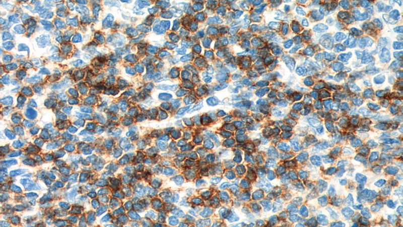 Immunohistochemistry of paraffin-embedded human tonsillitis tissue slide using Catalog No:109132(CD6 Antibody) at dilution of 1:200 (under 40x lens). heat mediated antigen retrieved with Tris-EDTA buffer(pH9).