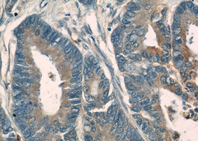 Immunohistochemical of paraffin-embedded human colon cancer using Catalog No:113859(PKM antibody) at dilution of 1:50 (under 40x lens)