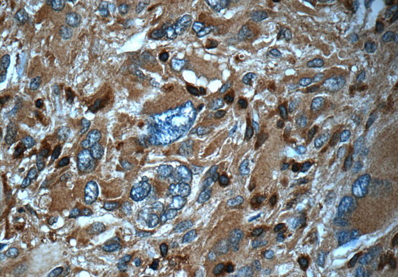 Immunohistochemistry of paraffin-embedded human gliomas tissue slide using Catalog No:108168(ARPC5 Antibody) at dilution of 1:50 (under 40x lens)