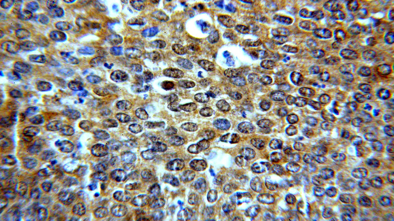Immunohistochemical of paraffin-embedded human cervical cancer using Catalog No:108540(BTF3L3-Specific antibody) at dilution of 1:50 (under 40x lens)