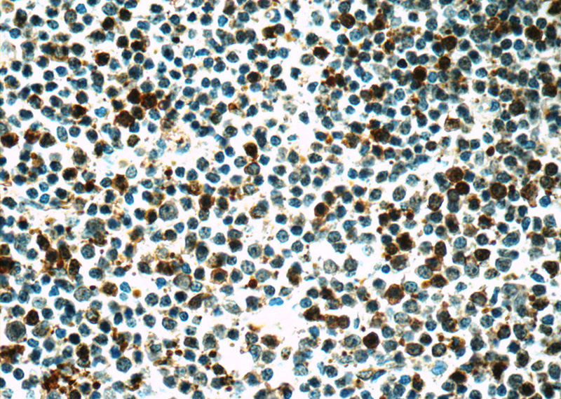Immunohistochemistry of paraffin-embedded human lymphoma tissue slide using Catalog No:107019(BMI1 Antibody) at dilution of 1:50 under 40x lens