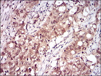 Immunohistochemical analysis of paraffin-embedded cervical cancer tissues using RELB mouse mAb with DAB staining.
