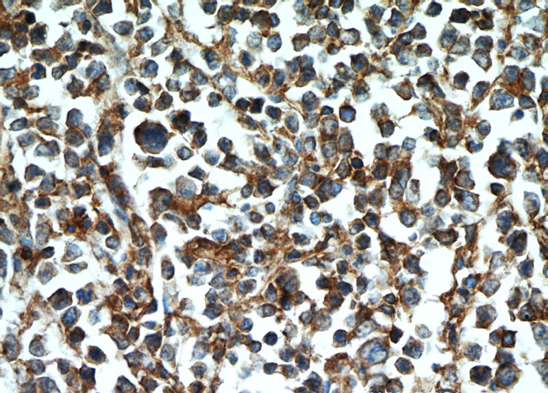 Immunohistochemical of paraffin-embedded human lymphoma using Catalog No:109125(CD45 antibody) at dilution of 1:50 (under 40x lens)