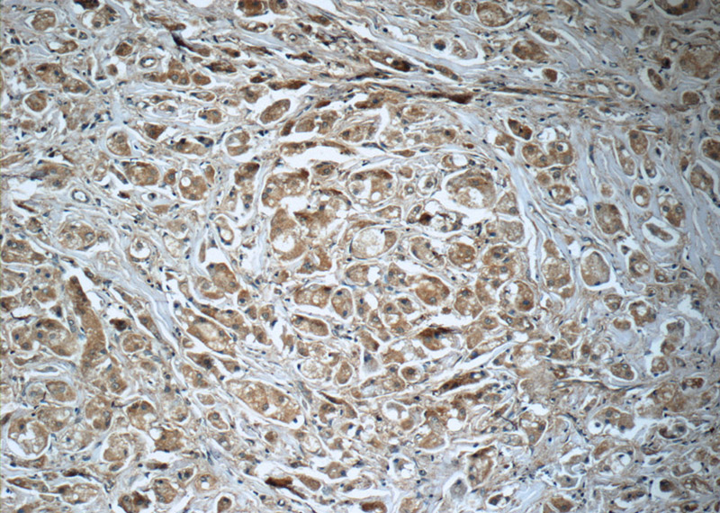 Immunohistochemistry of paraffin-embedded human breast cancer tissue slide using Catalog No:113722(Prx III Antibody) at dilution of 1:50 (under 10x lens)