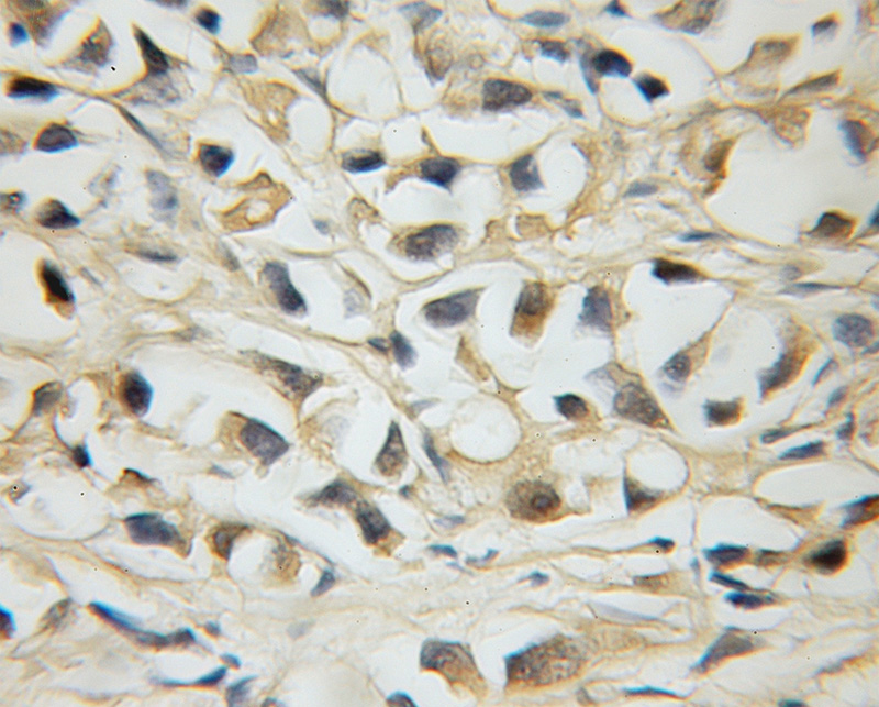 Immunohistochemical of paraffin-embedded human prostate cancer using Catalog No:112686(MLX antibody) at dilution of 1:50 (under 10x lens)