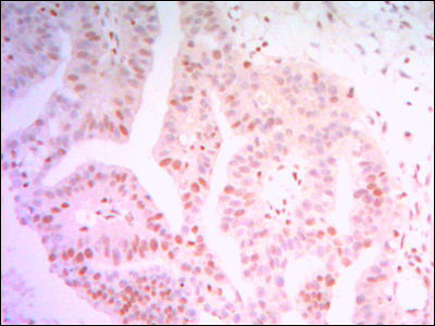 Fig3: Immunohistochemical analysis of paraffin-embedded human colon cancer tissue using anti-THAP11 antibody. Counter stained with hematoxylin.