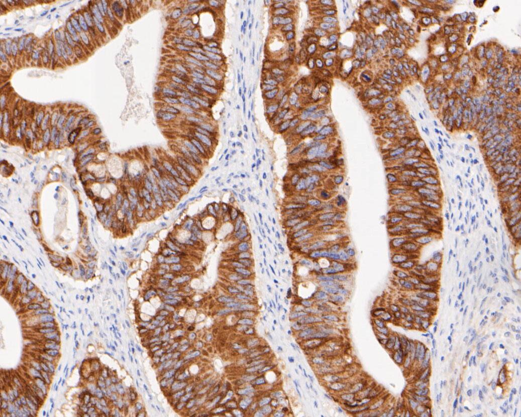 Fig2:; Immunohistochemical analysis of paraffin-embedded human Colon cancer tissue using anti-FAT1 antibody. The section was pre-treated using heat mediated antigen retrieval with sodium citrate buffer (pH 6.0) for 20 minutes. The tissues were blocked in 5% BSA for 30 minutes at room temperature, washed with ddH; 2; O and PBS, and then probed with the primary antibody ( 1/100) for 1 hour at room temperature. The detection was performed using an HRP conjugated compact polymer system. DAB was used as the chromogen. Tissues were counterstained with hematoxylin and mounted with DPX.