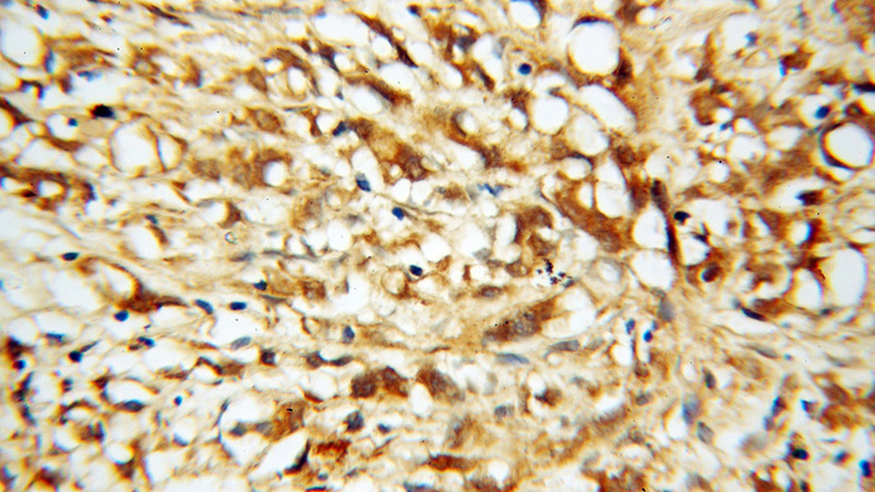 Immunohistochemical of paraffin-embedded human prostate cancer using Catalog No:114494(RABEP2 antibody) at dilution of 1:100 (under 40x lens)