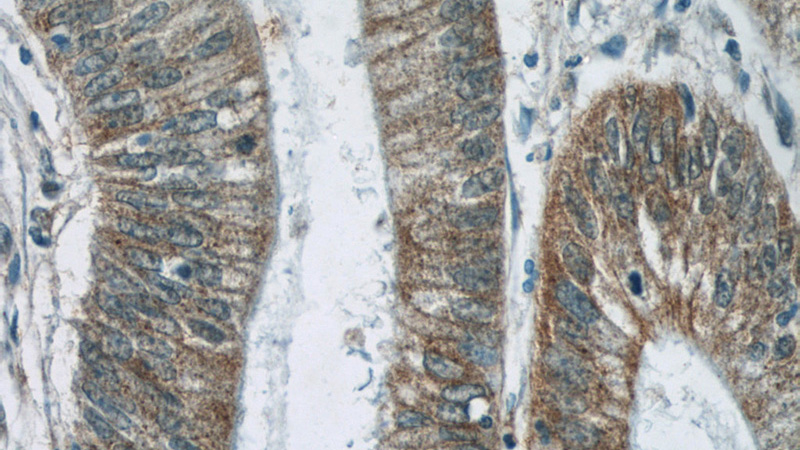 Immunohistochemistry of paraffin-embedded human colon cancer tissue slide using Catalog No:116111(TMEM190 Antibody) at dilution of 1:50 (under 40x lens)