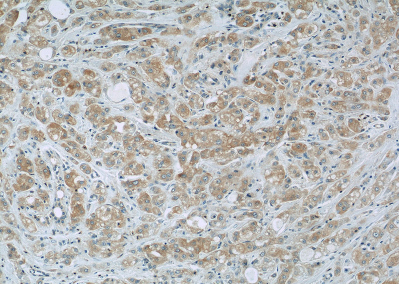 Immunohistochemistry of paraffin-embedded human breast cancer slide using Catalog No:114629(TRIM13 Antibody) at dilution of 1:50