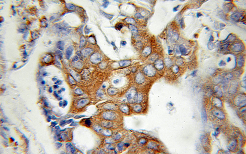 Immunohistochemical of paraffin-embedded human colon cancer using Catalog No:108421(BCAP31 antibody) at dilution of 1:100 (under 10x lens)