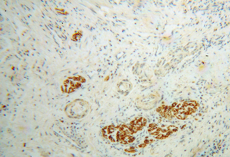 Immunohistochemical of paraffin-embedded human colon cancer using Catalog No:110021(DRG2 antibody) at dilution of 1:100 (under 10x lens)