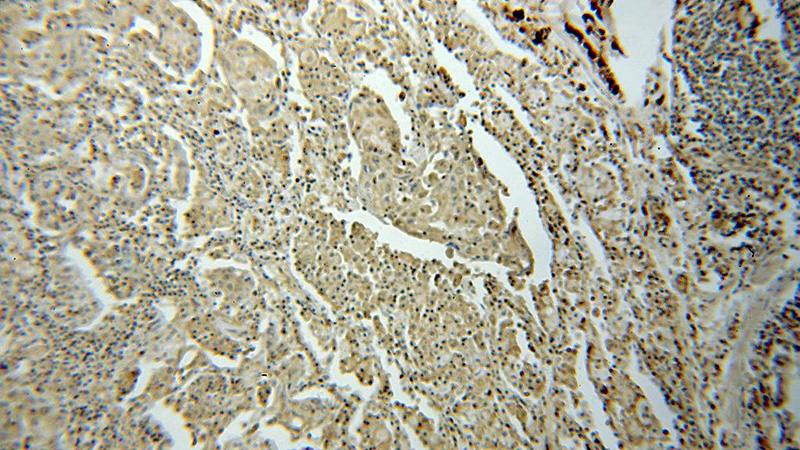 Immunohistochemical of paraffin-embedded human lung cancer using Catalog No:115111(SEPHS1 antibody) at dilution of 1:100 (under 10x lens)