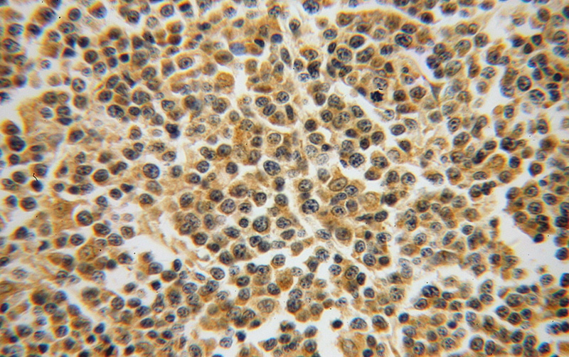 Immunohistochemical of paraffin-embedded human lymphoma using Catalog No:111161(GRAP antibody) at dilution of 1:50 (under 40x lens)