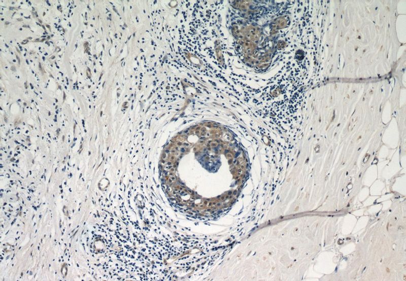 Immunohistochemical of paraffin-embedded human breast cancer using Catalog No:107740(ACK1 antibody) at dilution of 1:50 (under 10x lens)