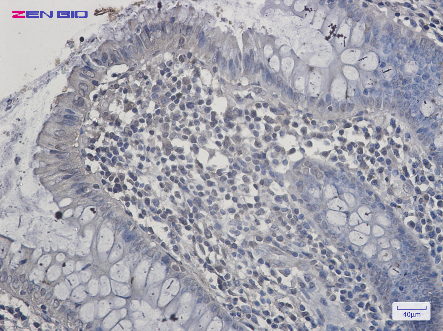 Immunohistochemistry of SIRT2 in paraffin-embedded Human colon cancer tissue using SIRT2 Rabbit pAb at dilution 1/20