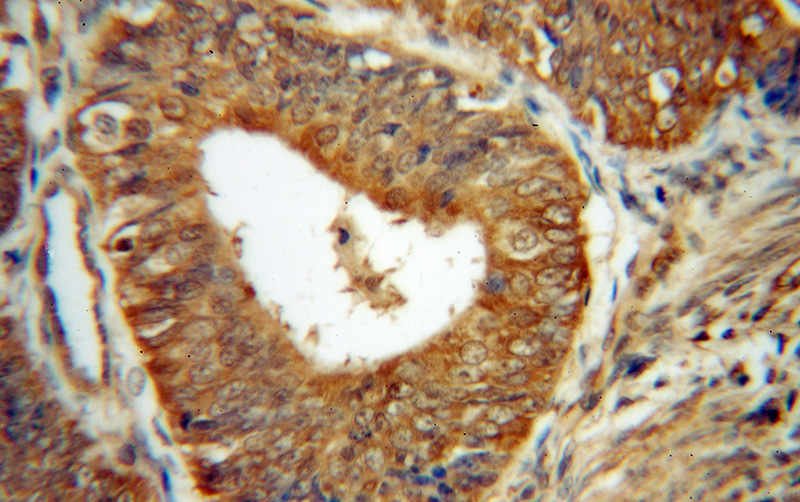 Immunohistochemical of paraffin-embedded human endometrial cancer using Catalog No:109627(CUTC antibody) at dilution of 1:100 (under 40x lens)