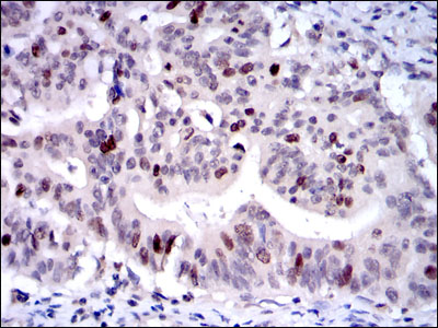 Immunohistochemical analysis of paraffin-embedded rectum cancer tissues using KID mouse mAb with DAB staining.