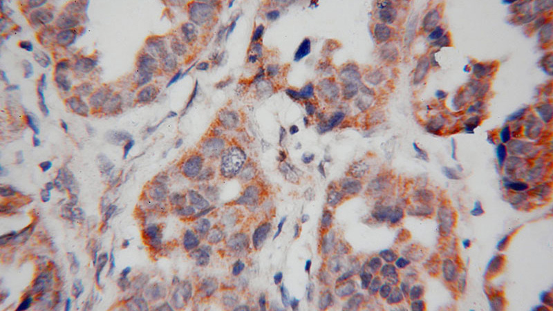Immunohistochemical of paraffin-embedded human lung cancer using Catalog No:114028(PMPCB antibody) at dilution of 1:100 (under 40x lens)