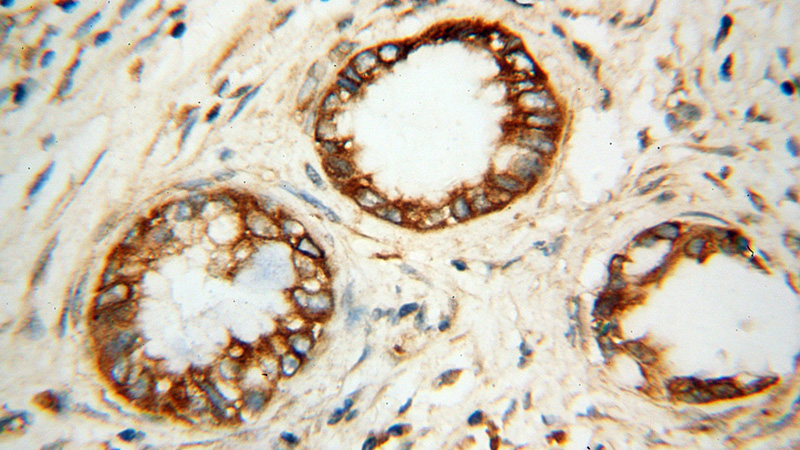 Immunohistochemical of paraffin-embedded human pancreas cancer using Catalog No:115127(ATP2A3 antibody) at dilution of 1:100 (under 40x lens)