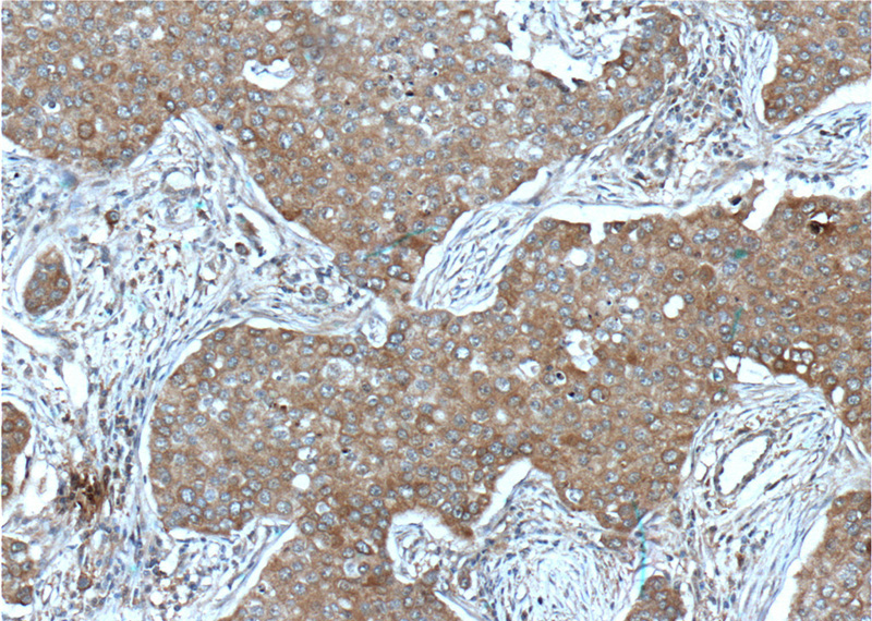Immunohistochemistry of paraffin-embedded human breast cancer tissue slide using Catalog No:107280(IGF1R-Specific Antibody) at dilution of 1:200 (under 10x lens). heat mediated antigen retrieved with Tris-EDTA buffer(pH9).