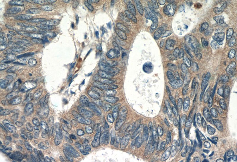 Immunohistochemistry of paraffin-embedded human colon cancer tissue slide using Catalog No:114844(RPS3 Antibody) at dilution of 1:50 (under 40x lens)
