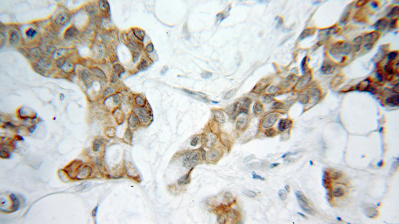 Immunohistochemical of paraffin-embedded human pancreas cancer using Catalog No:114294(PSAT1 antibody) at dilution of 1:10 (under 10x lens)