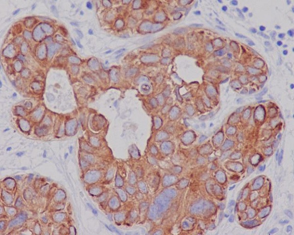 Immunohistochemical analysis of paraffin-embedded human breast carcinoma, using Cytokeratin 7 Antibody  .