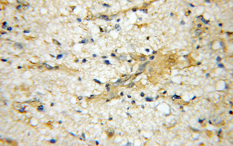 Immunohistochemical of paraffin-embedded human gliomas using Catalog No:116793(VPS52 antibody) at dilution of 1:50 (under 10x lens)