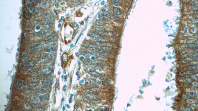 Immunohistochemistry of paraffin-embedded human colon cancer tissue slide using Catalog No:108785(C6orf70 Antibody) at dilution of 1:50 (under 40x lens)