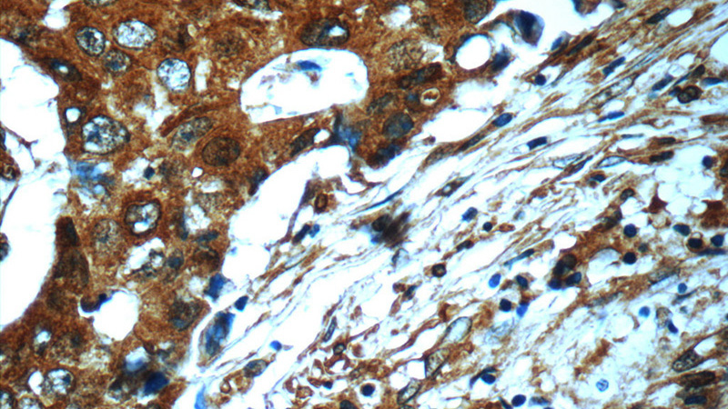Immunohistochemistry of paraffin-embedded human breast cancer slide using Catalog No:113603(PAWR Antibody) at dilution of 1:50