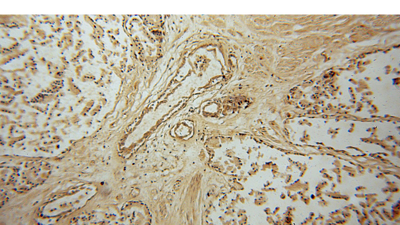 Immunohistochemical of paraffin-embedded human prostate cancer using Catalog No:114281(PRSS8 antibody) at dilution of 1:50 (under 10x lens)
