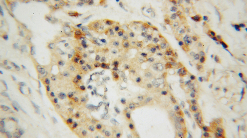 Immunohistochemical of paraffin-embedded human pancreas cancer using Catalog No:108296(ATG4B antibody) at dilution of 1:50 (under 40x lens)