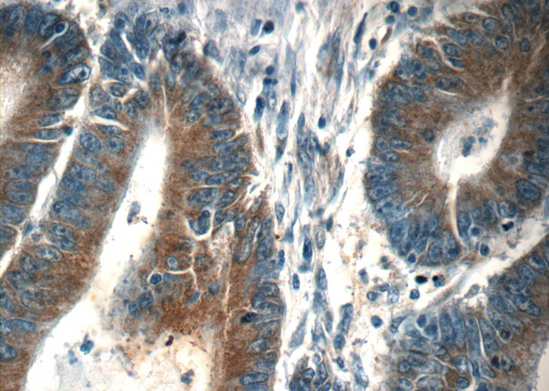 Immunohistochemistry of paraffin-embedded human colon cancer tissue slide using Catalog No:107598(SND1 Antibody) at dilution of 1:50 (under 40x lens)