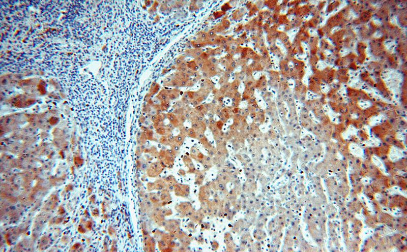Immunohistochemical of paraffin-embedded human hepatocirrhosis using Catalog No:113065(NDUFA9 antibody) at dilution of 1:50 (under 10x lens)