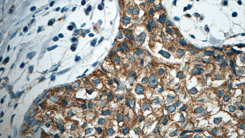 Immunohistochemistry of paraffin-embedded human breast cancer tissue slide using Catalog No:108131 (APC Antibody) at dilution of 1:50. Heat mediated antigen retrieved with Citric acid buffer, pH6.0.