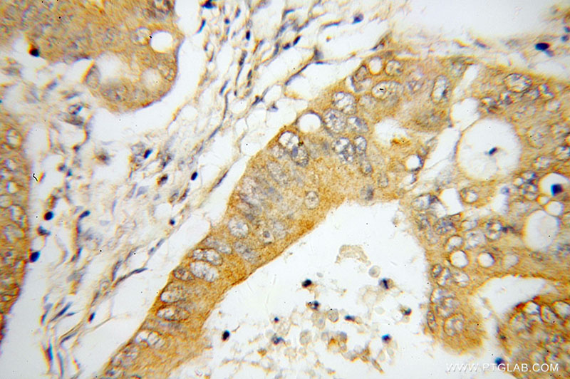 Immunohistochemical of paraffin-embedded human colon cancer using Catalog No:112987(MYO7B antibody) at dilution of 1:50 (under 40x lens)