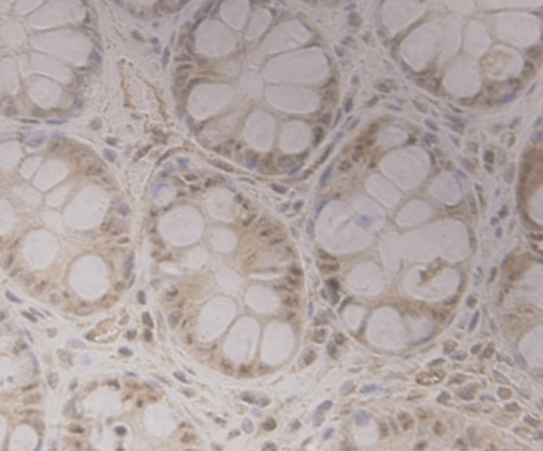 Fig6: Immunohistochemical analysis of paraffin-embedded human colon tissue using anti-GRAMD1A antibody. Counter stained with hematoxylin.