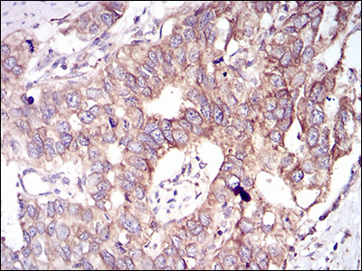 Immunohistochemical analysis of paraffin-embedded esophageal cancer tissues using GSK3B mouse mAb with DAB staining.
