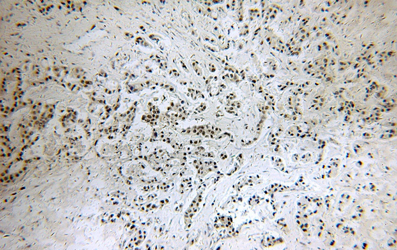 Immunohistochemical of paraffin-embedded human breast cancer using Catalog No:114362(PYGO2 antibody) at dilution of 1:50 (under 10x lens)