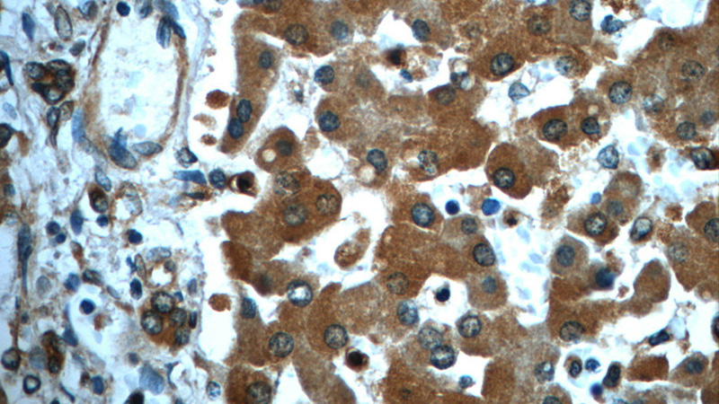 Immunohistochemistry of paraffin-embedded human liver slide using Catalog No:115452(SND1 Antibody) at dilution of 1:50