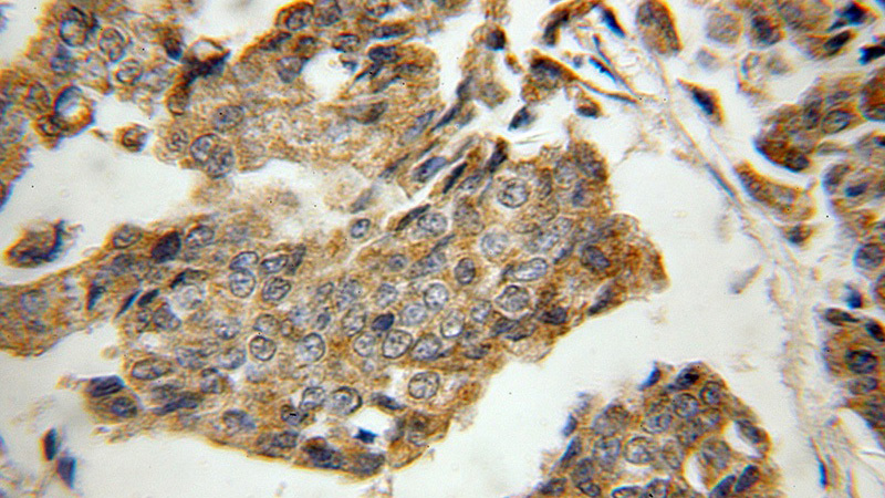 Immunohistochemical of paraffin-embedded human breast cancer using Catalog No:112111(KLRG1 antibody) at dilution of 1:50 (under 40x lens)