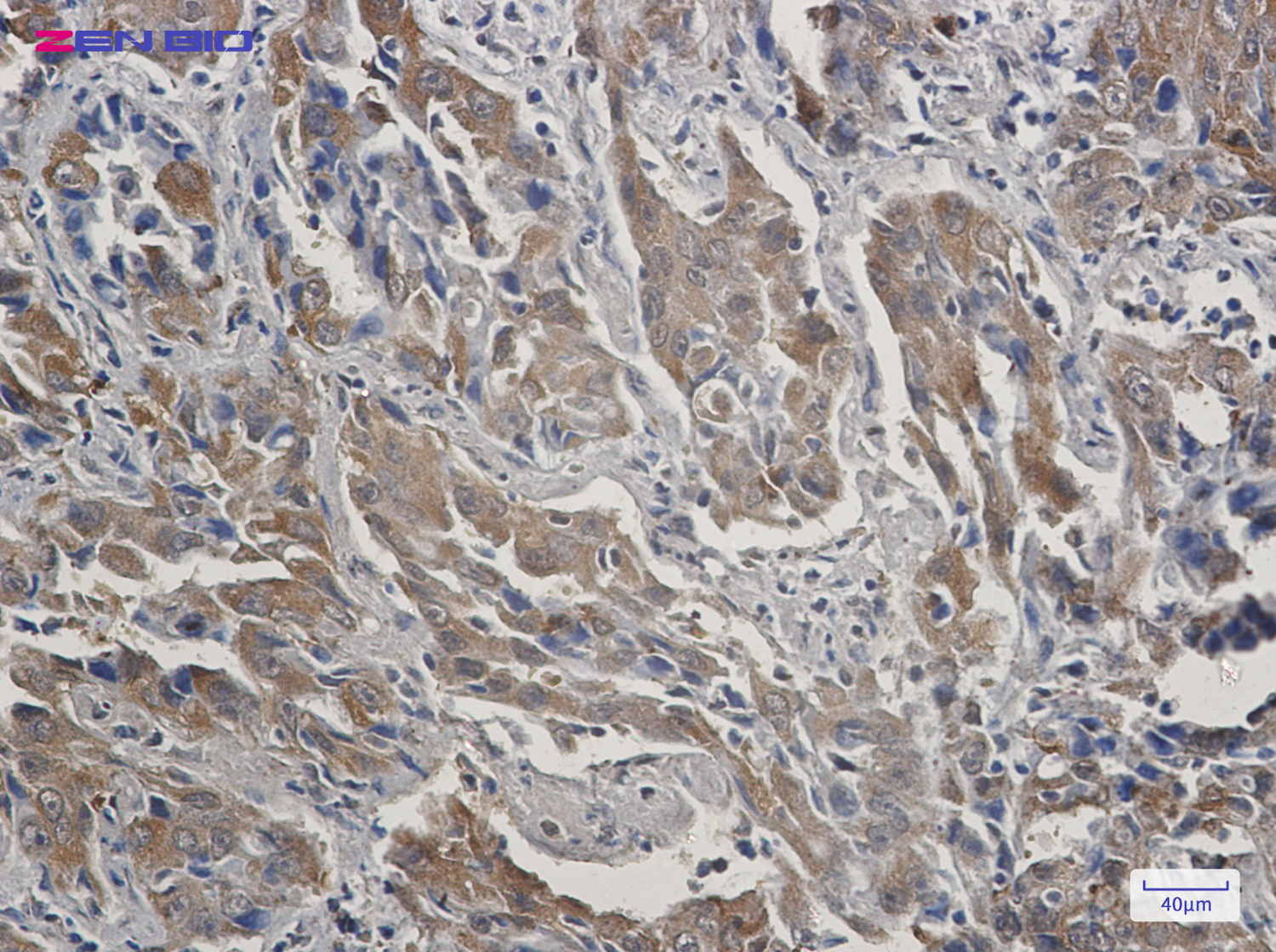 Immunohistochemistry of STIP1 in paraffin-embedded Human lung cancer tissue using STIP1 Rabbit pAb at dilution 1/20